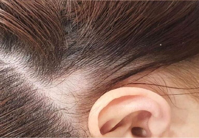 Paciente antes de mesoterapia capilar en Área Capilar Madrid - Caso 3