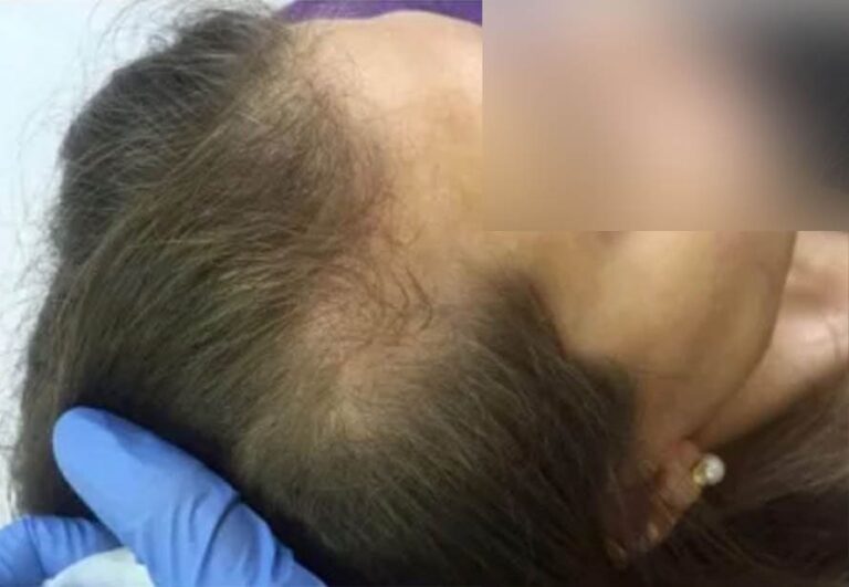 Paciente antes de mesoterapia capilar en Área Capilar Madrid - Caso 5