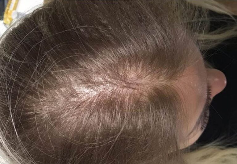 Paciente antes de mesoterapia capilar en Área Capilar Madrid - Caso 6