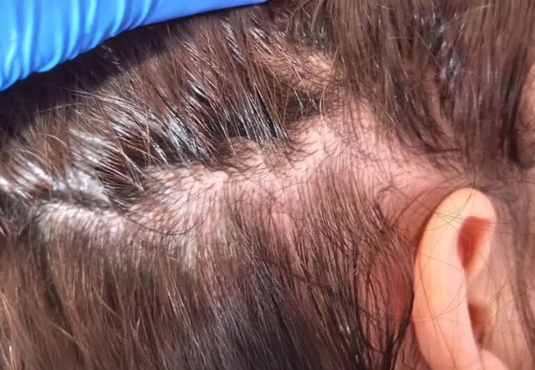 Paciente antes de mesoterapia capilar en Área Capilar Madrid - Caso 7