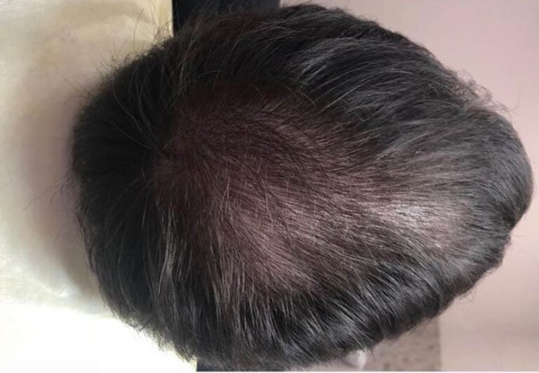 Resultado después de mesoterapia capilar en Área Capilar Madrid - Caso 1