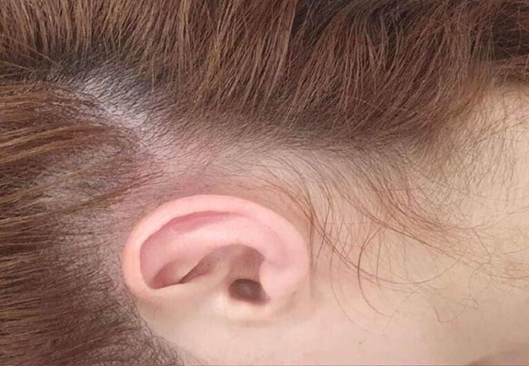 Resultado después de mesoterapia capilar en Área Capilar Madrid - Caso 3