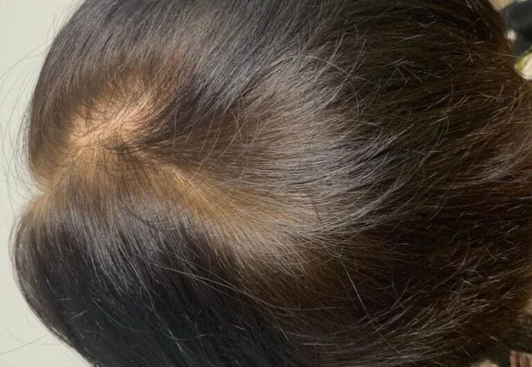 Resultado después de mesoterapia capilar en Área Capilar Madrid - Caso 4