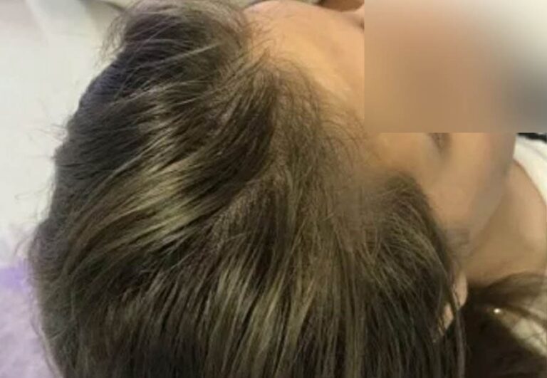 Resultado después de mesoterapia capilar en Área Capilar Madrid - Caso 5