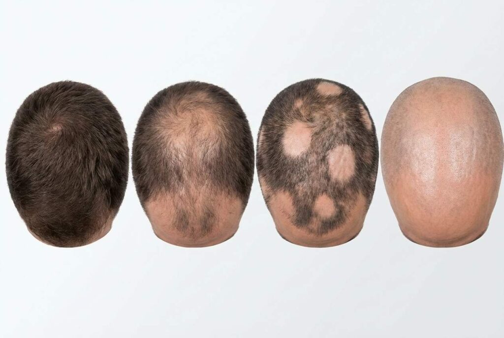 Alopecia: Qué Es, Causas y Tipos