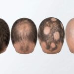 Alopecia: Qué Es, Causas y Tipos
